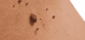 skin tag