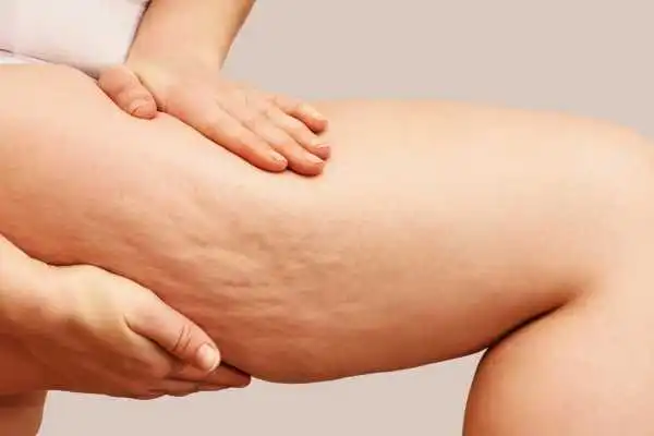 Image of woman showing leg with cellulite Macclesfield