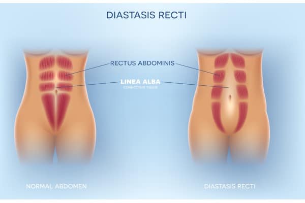 What Non-Surgical Options Are Available for Diastasis Recti Macclesfield?