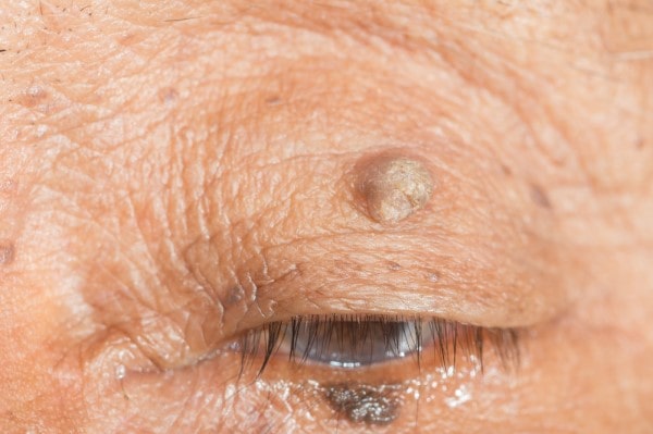Skin imperfections Macclesfield - Cryopen is fast and effective book in today!