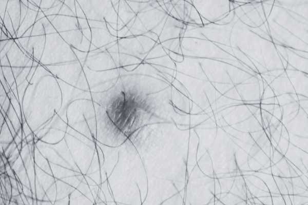 Dermatofibroma removal Macclesfield made simple! Book in today!