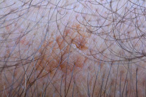seborrheic keratosis