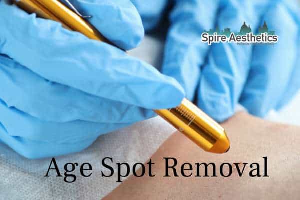 age spot removal