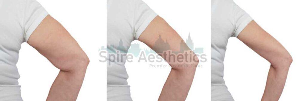 before and after cryolipolysis