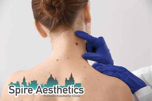 benign mole removal