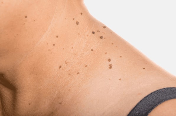 Are you looking for easy skin tag removal Macclesfield - then contact Spire today!