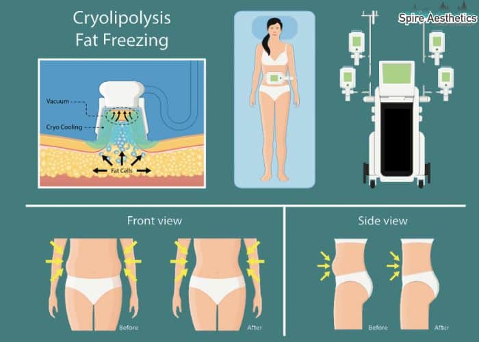 Image of diet and fat freezing combined for best results for Spire Aesthetics Macclesfield