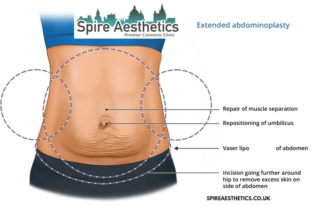 Understanding Loose Skin After Gastric Band Macclesfield Surgery and HIFU Treatment 