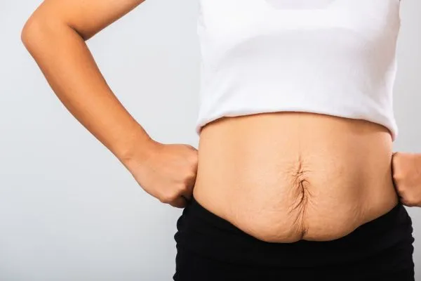Image of a woman's stomach after weight loss with sagging skin following a gastric band Macclesfield