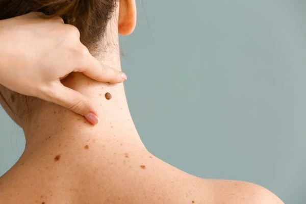Prices and promotions for blemish removal Macclesfield contact our team today!