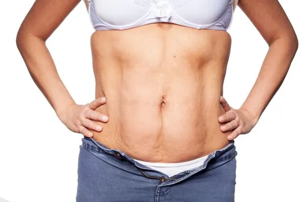 sagging skin on woman's stomach after weight loss injections Macclesfield