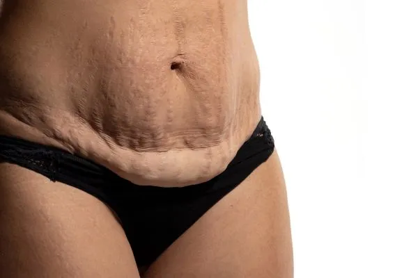 Image of womans stomach after weight loss injections Macclesfield showing saggy skin
