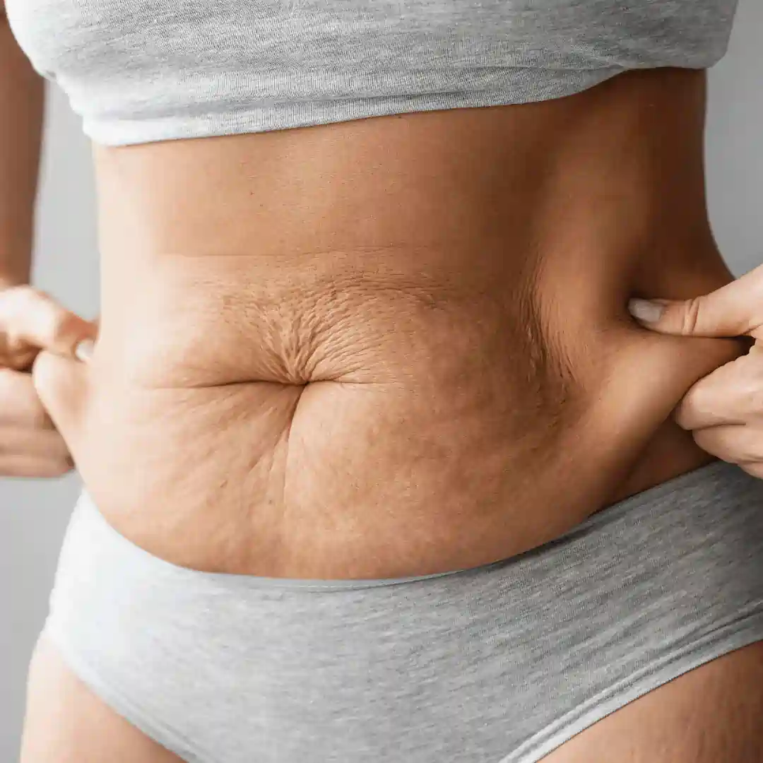Is It Normal to Have Loose Skin After Pregnancy Macclesfield?