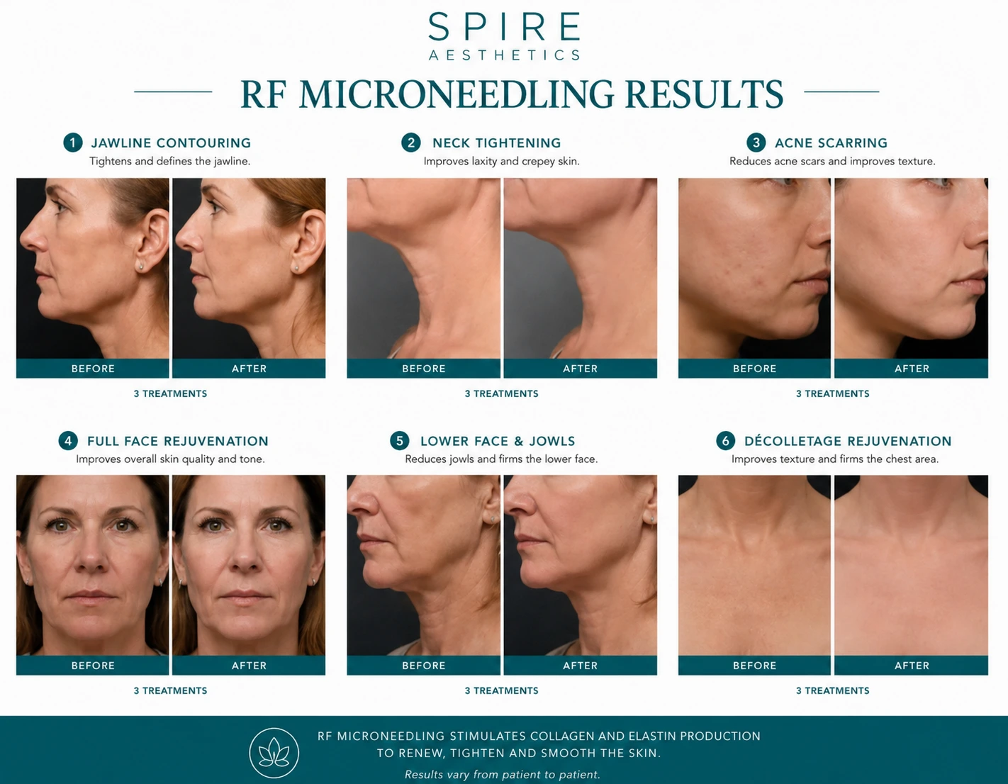 RF Microneedling Skin tightening Macclesfield results