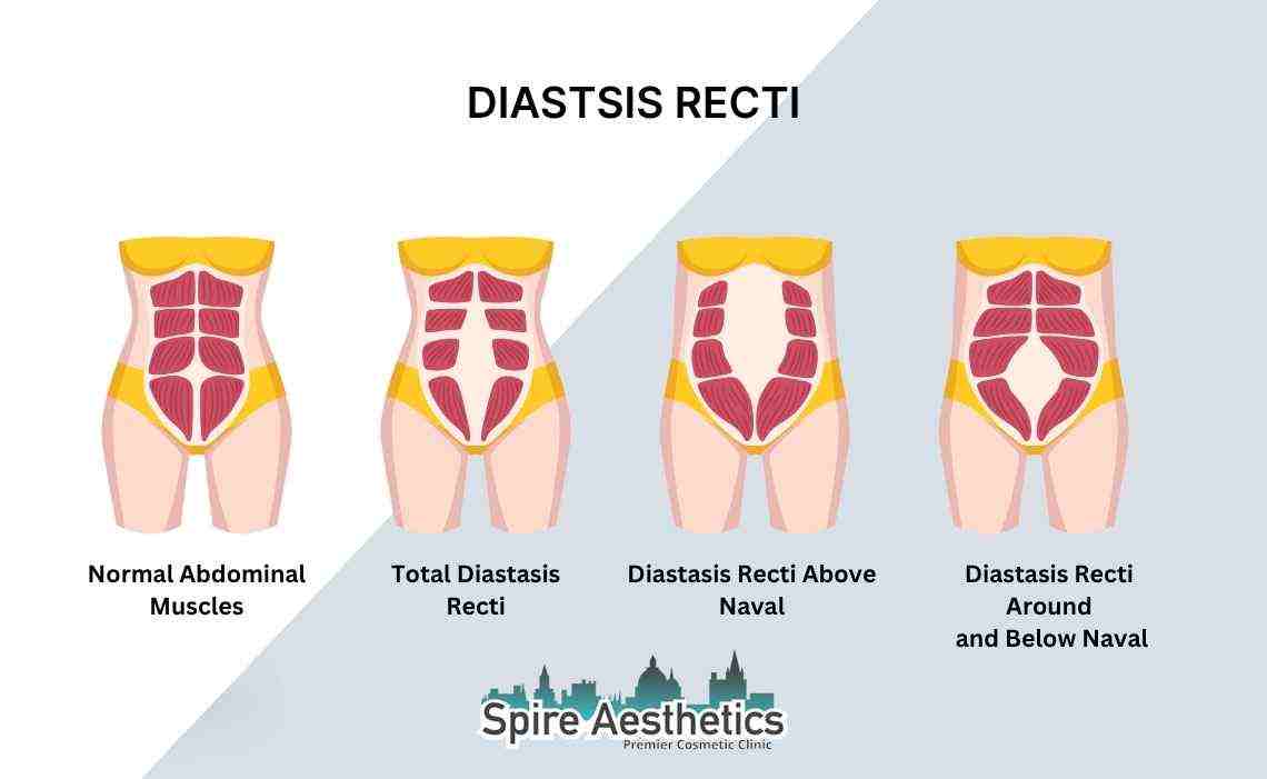 Is Non-Surgical Diastasis Recti Treatment Right for You? Common Concerns Answered Macclesfield